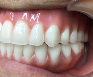 ea1e129b Por que trocar sua prótese fixa sobre dentes por implante com coroa?