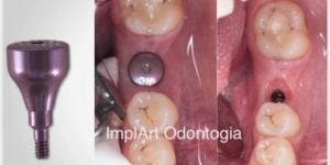 eb618a8c Tratamento para bolsa periodontal