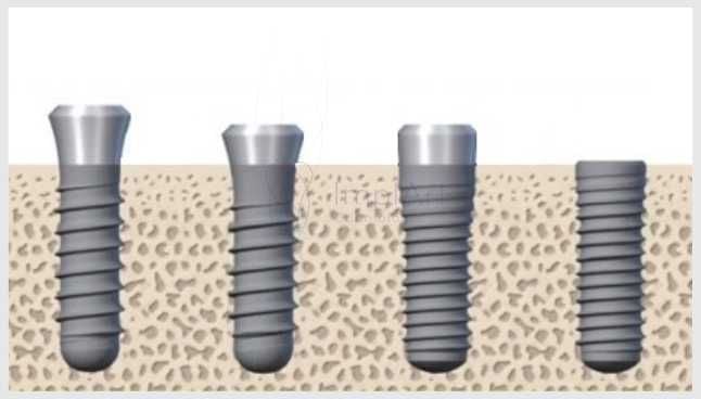 ec27d440 Como ocorre a Osseointegração de Implantes Dentários?