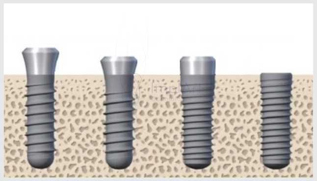 implante_osseointegracao_25kb-ec27d440 Como ocorre a Osseointegração de Implantes Dentários?