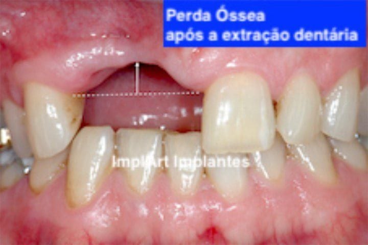 ed1f9e74 Perda óssea nos dentes: O que é | Porque acontece| Tratamento