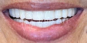 ed43f7f5 Como saber se o dente precisa de tratamento de canal?