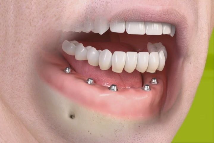ed9f9b65 Implante dental - 4 coisas que você precisa saber antes de fazer o seu