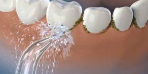 waterpik-e-irrigador-dental-ed84d622 Implante dentário - perguntas ao especialista - entrevista