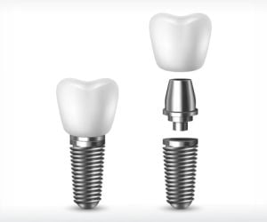 eeed093f Por que trocar sua prótese fixa sobre dentes por implante com coroa?