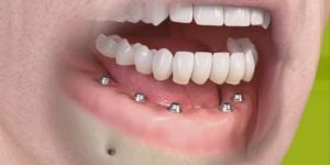 eefacbb3 Prótese dentária de porcelana ou de resina?