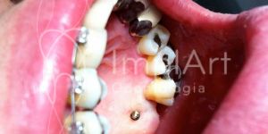 f014c858 Câncer e tratamento dentário