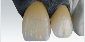 zolid_zirconia_cubica_37kb-f0d9565b Infecção nos dentes pode causar doenças no coração