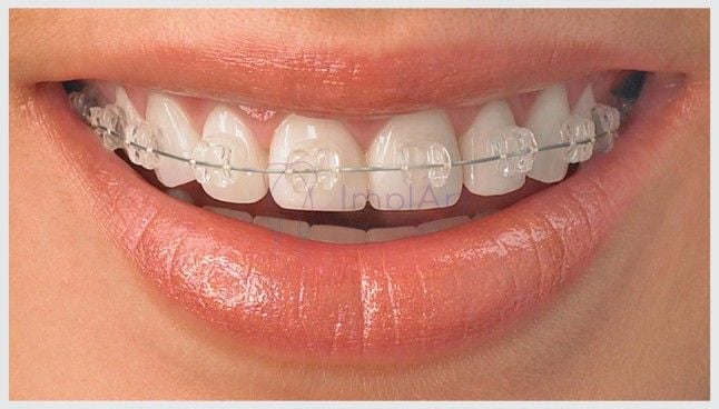 f2278065 Implante dentário em quem usa aparelho ortodôntico