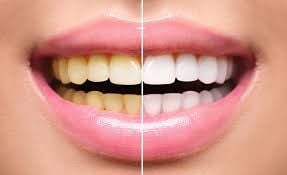 f2afef70 Maneiras simples de clareamento natural dos dentes funcionam?