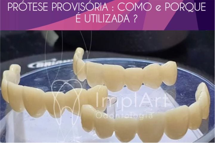 PROTESES-PROVISORIAS-COMO-E-PORQUE-E-UTIIZADA-f3537afe Implante dental: prótese provisória ajuda na estética final