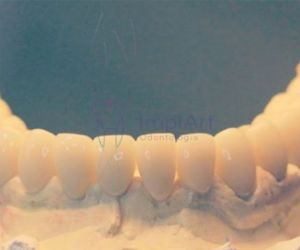 implante_total_dentes_individualizados_50kb-f355039b Enxerto ósseo biomolecular para implante