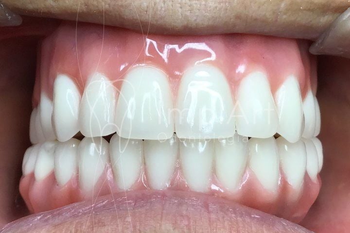 f6536f66 Implante dentário para a boca toda é um tratamento fácil e gratificante