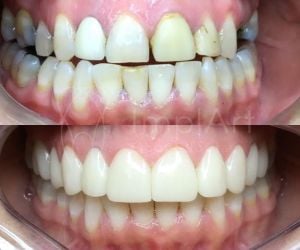 f6a59e5e Recuperação de um implante dentário: quanto tempo?