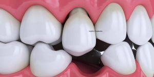 f75502a5 Prótese dentária fixa de porcelana sobre dentes com ou sem gengiva