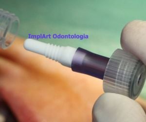 f7ca84e5 Rejeição de implante dentário: pode ocorrer?