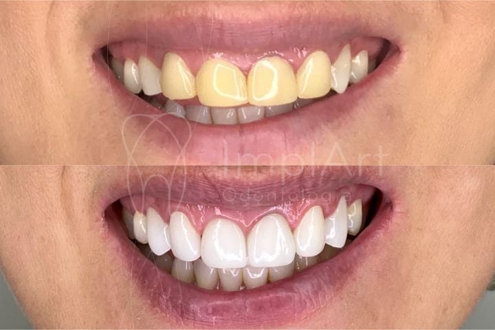 f7d2f164 Facetas de porcelana ultra finas - lentes de contato