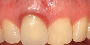 dente_inflamado-f9f9b6be Implantes dentário antes e depois