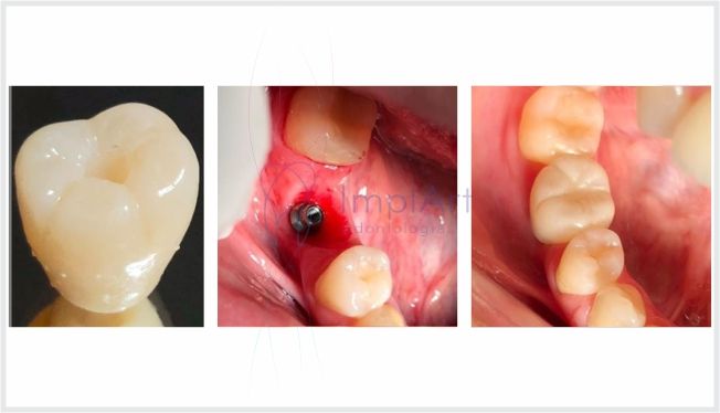 fa5606f7 Coroa de zircônia pura para implantes