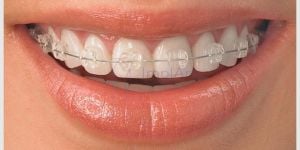 fbebb7c1 Quantos implantes dentários são colocados de cada vez?