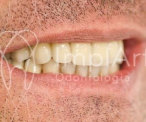 fc121ed7 O que fazer quando surge uma cárie dentária?