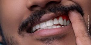 fd43572f Vídeo: cirurgia de implante dentário