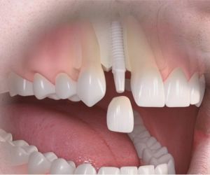 fe383dc5 Restaurando Sorrisos com Precisão: Implante Dentário Parcial na Clínica ImplArt