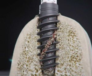 fea7b6b3 Recuperação de um implante dentário: quanto tempo?