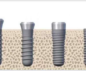 fed8edae Prótese protocolo de resina com estrutura de titânio