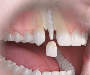 implante_straumann_pure_ceramic_49kb-fe383dc5 Restaurando Sorrisos com Precisão: Implante Dentário Parcial na Clínica ImplArt