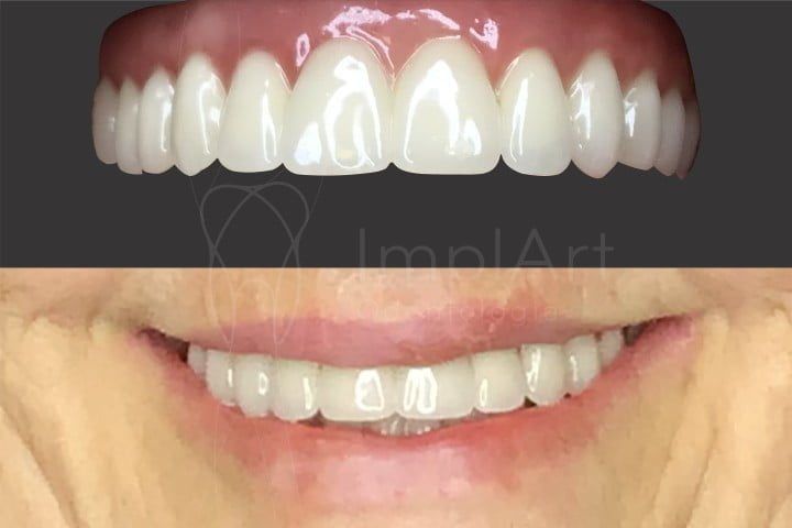 ff7b0af7 Estética natural após implantes dentários